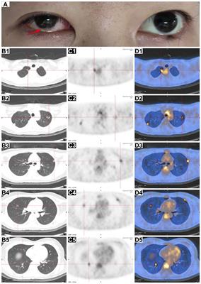 Case report: Unveiling the silent threat in the ICU – a case of disseminated invasive aspergillosis in a patient with fulminant myocarditis